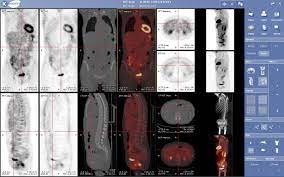 National coverage determination (ncd) for positron emission tomography (pet) scans (220.6). Pet Ct Wikipedia