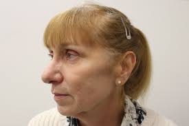 HOW I DO IT Approaches to non-surgical face lifting