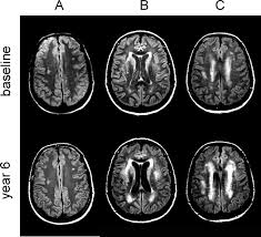 Progression Of Leukoaraiosis And Cognition Stroke