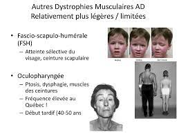La france fait un peu mieux. Armstrong Gangster Saggio Myopathie Des Ceintures Esperance De Vie Riuscito Piuttosto Solo