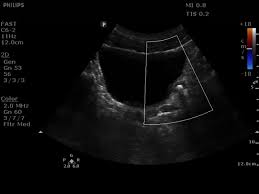Image result for Nephrolithiasis