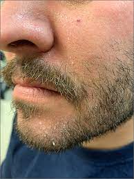 Scaly Beard Rash | Mdedge Family Medicine