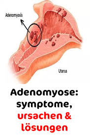 Endometriosis especially when the endometrial tissue invades the myometrium. Adenomyose Symptome Ursachen Losungen Endometriose Ursache Fischol