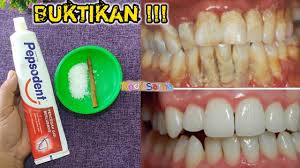 Kurang Dari 5 Menit Karang Gigi Rontok Putih Bersih Bebas Plak Youtube