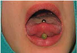 Barbell Shaped Tongue Piercing Download Scientific Diagram