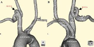 img to under the radio: Visible Bigeminal Pulses With Tortuous Common Carotid Artery Bmj Case Reports
