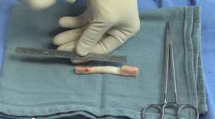 Meniscus tear surgery is a surgical procedure performed to correct or treat one or more of the fibrocartilage strips in the knee, known as menisci. The Cost Of An Acl Injury