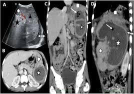 Image result for Splenic Abscess