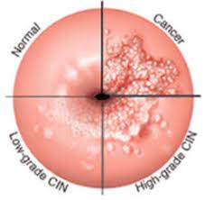 Hpv Abnormal Pap Smear Treatment Sonoma Naturopathic Medicine
