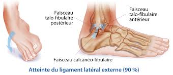 La cheville, également appelée région talocrurale, est la zone de jonction entre le pied et la jambe. Entorse De Cheville L Accompagnement De L Osteopathe Osteopathe Paris