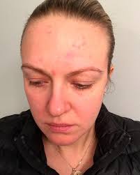 A before and after that is purely porefection! The gorgeous  @thebeautyfriend_13 added Finely Awake Plantfoliant 🌱 and Peat Perfection  Mask to her daily skincare routine...and the results are nothing short of  fantastic!