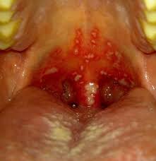 Image result for Mouth ulcers symptoms roof of the mouth