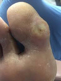 We did not find results for: Diabetic Wound Care Pittsburgh Beaver Valley Foot Clinic