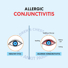 Image result for Allergic Conjunctivitis