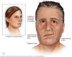 You also have a greater chance of it if you have Bell S Palsy Symptoms And Causes Mayo Clinic