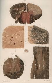 La esclerosis múltiple es una enfermedad autoinmune, que afecta al sistema nervioso central, cerebro, médula espinal y tronco del encéfalo. Esclerosis Multiple Wikipedia La Enciclopedia Libre