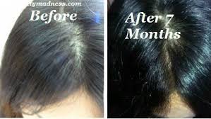 How To Regrow Hair On Bald Head Powerful Natural Solutions Regrow Hair Regrow Hair Women Excessive Hair Loss