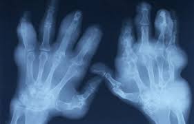 Image result for XRay Changes in Rheumatic Conditions