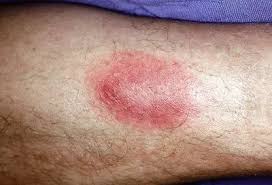 Image result for Tick Bite