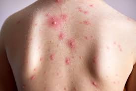 15 Home Remedies For Chickenpox For Faster Recovery