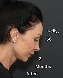 🤌🤌Plastic surgery doesn't have to look plastic. 😍😍Margot is 58 years  old. She is almost 4 months postop deep plane facelift, deep necklift, brow  lift, upper blepharoplasty, lower blepharoplasty, corner lip reset,