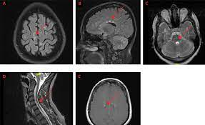 Multiple sclerosis (ms) is a disease where patches of inflammation occur in parts of your brain and/or spinal cord. Multiple Sclerosis