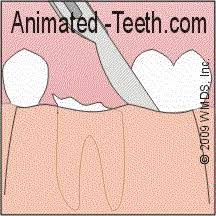 Dental Stitches Dissolving Vs Regular As Used With Tooth Extractions Wisdom Teeth