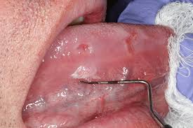 Image result for papillomavirus tongue)
