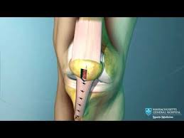 Anterior Cruciate Ligament Acl Reconstruction Animation Acl Surgery Acl Reconstruction Surgery Cruciate Ligament