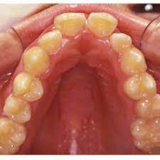 Pdf Oral Health In Individuals With Down Syndrome