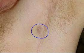 Ingrown hairs can look like raised, red, itchy spots on the skin. Ingrown Armpit Hair Lymph Node Pictures Lump How To Get Rid Home Remedies Symptoms Infected Underarm Boil