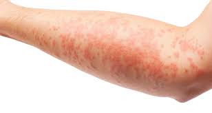 Image result for dermatitis contacta children