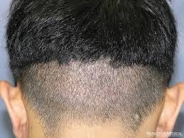 Pin On Hair Transplant
