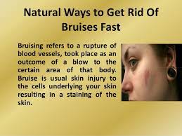 Natural Ways To Get Rid Of Bruises Fast