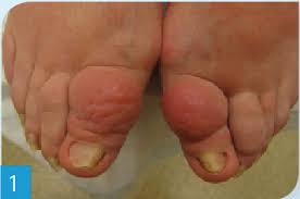 Image result for Clubbing nails feet