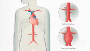 Um aneurisma de aorta abdominal (aaa) consiste de uma protuberância cheia de sangue em uma parte da aorta que passa pelo abdômen. Que Son Los Aneurismas De Aorta Hospital Clinic Barcelona