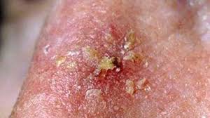 Skin cancer is by far the most common type of cancer. Skin Cancer Symptoms Pictures Types And More