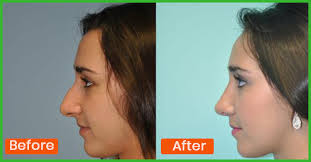Human nasal volume, linear distance and area increase as we age, and the nasal tip angle droops, or appears to, as we age. 7 Unbelievable Exercises That Will Help Keep Your Nose In Shape