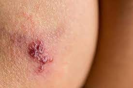 If you do not know how shingles actually look like, you will never be able to differentiate them from other blistery rashes and get timely treatment for the same. Is It Shingles Symptoms Vs Other Conditions And Causes