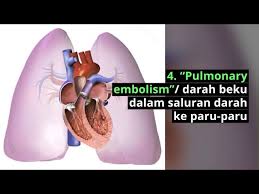 Ia sememangnya benar namun penyediaannya perlu bertepatan dengan gaya hidup sihat yang. Sakit Dada Sebelah Kanan Penyebab Cara Mengatasi Doctoroncall