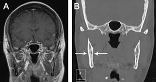 Teaching Neuroimages Numb Chin Syndrome In A Patient With Breast Cancer Neurology