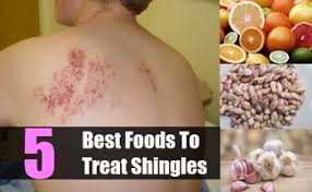 Diet For Shingles Diet