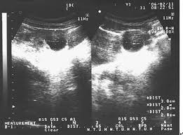 Ovarian Remnant Syndrome At The Port Site Journal Of Minimally Invasive Gynecology