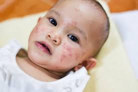 You have just read the article entitled bintik merah di muka bayi selepas demam. Bentol Berair Pada Kulit Bayi 4 Penyebab Plus Cara Mengatasinya
