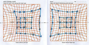 Hess Chart Of The Same 27 Year Old Woman Shown In With