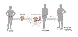 Image result for Transplantation
