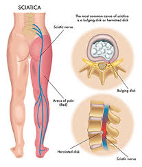 Can a chiropractor help a pinched nerve in the back. Can A Chiropractor Help With Sciatica Taylor Chiropractic Wellness