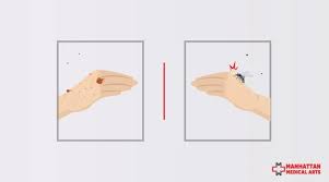 Image result for flea bites