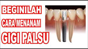 We did not find results for: Beginilah Cara Menanam Gigi Palsu By Afiq Al Fatih