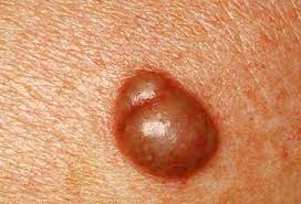 Skin Problems Skin Conditions Below The Waist